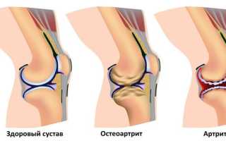 Почему болит коленка