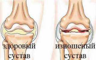 Гонартроз коленного