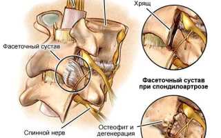 Какой врач лечит спондилоартроз