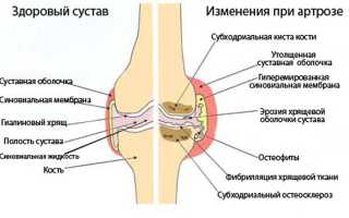 Чем лечат артроз