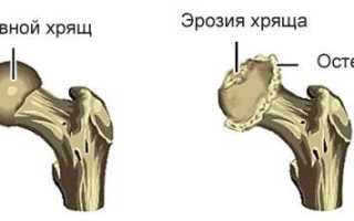 Лечение тазобедренного сустава