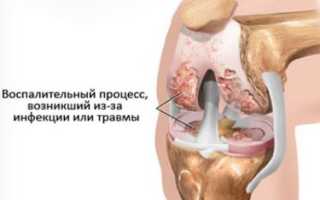 Боль под коленом при сгибании