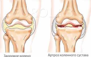 Деформированный артроз