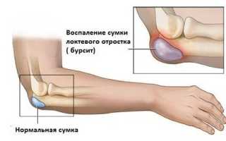 Лечение локтевого бурсита в домашних условиях