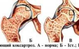 Тазобедренный сустав упражнения