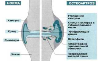 Питание при остеоартрозе коленного сустава
