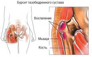 Бурсит вертельной сумки