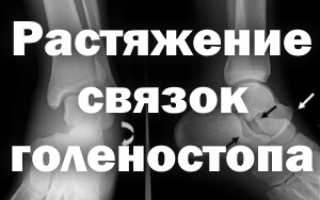 Мазь при растяжении голеностопа