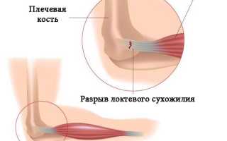 Растяжение связок локтя