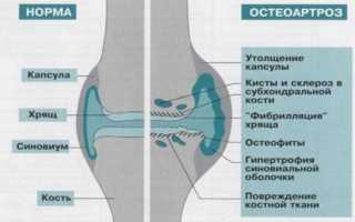 Остеоартроз степени