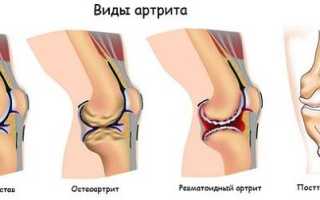 Артрит 3 степени