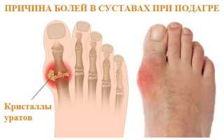 Подагра на большом пальце ноги лечение