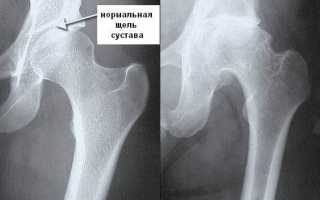 Лечебная гимнастика при коксартрозе