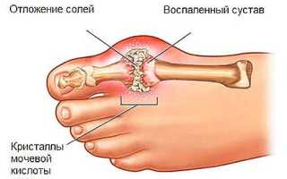 Меню при подагре рецепты