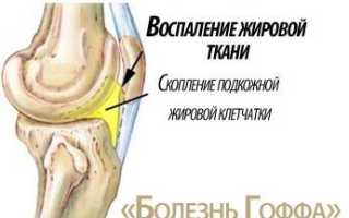 Болезнь гоффа коленного
