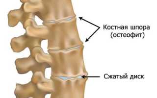 Лфк при остеохондрозе шейного отдела позвоночника