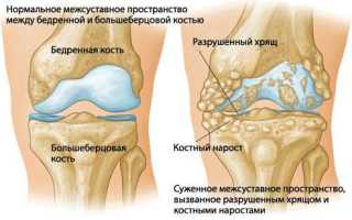 Артрит колена лечение