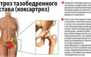 Коксартроз причины