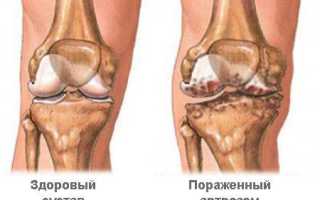Как лечить артроз суставов