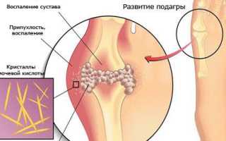 Подагра большого пальца ноги