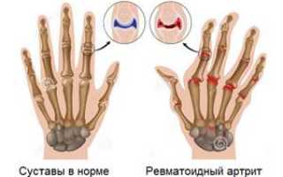 Анализ крови при ревматоидном артрите